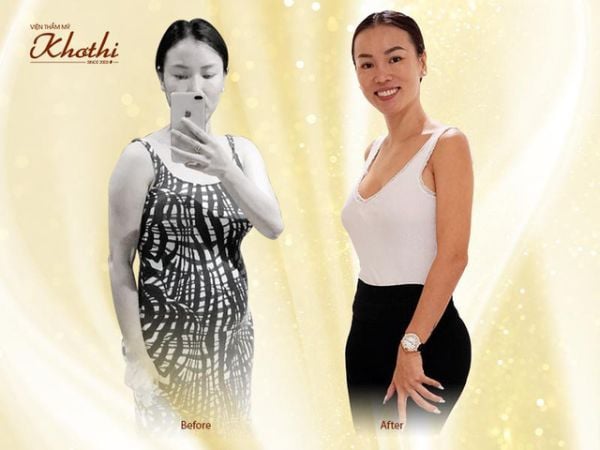 Giảm cân an toàn sau sinh bằng Miko Diet độc quyền của Khơ Thị