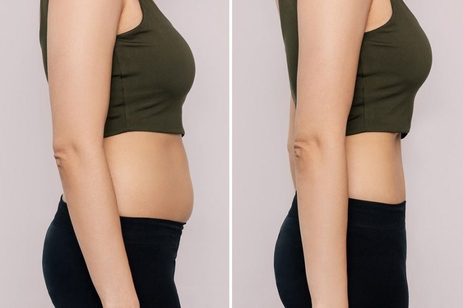 giảm mỡ bụng không xâm lấn