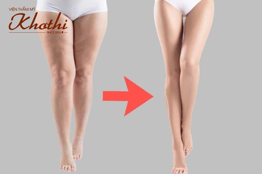 Giảm mỡ đùi bằng công nghệ cao không cần tốn nhiều thời gian nghỉ dưỡng