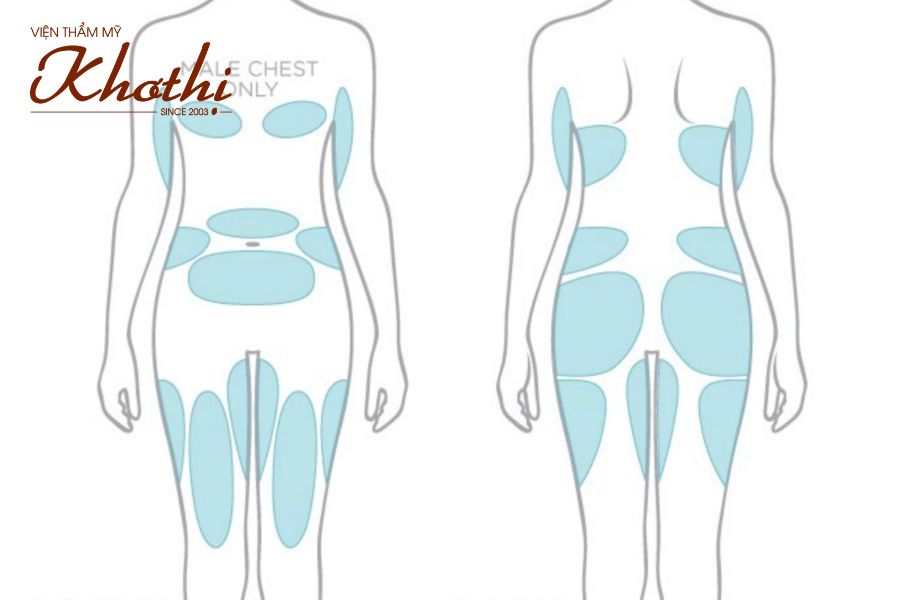 Những vùng có thể điều trị giảm mỡ bằng công nghệ cao