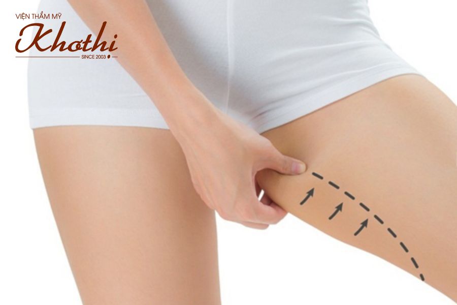 Công nghệ cải tiến độc quyền Khơ Thị Miko Diet giảm mỡ đùi cấp tốc