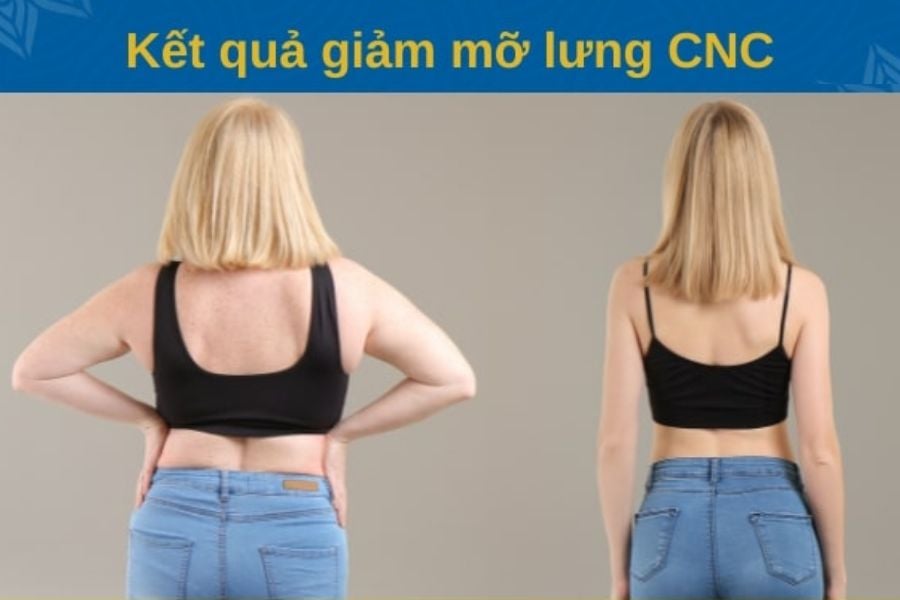phương pháp giảm mỡ lưng nách hiện đại và an toàn