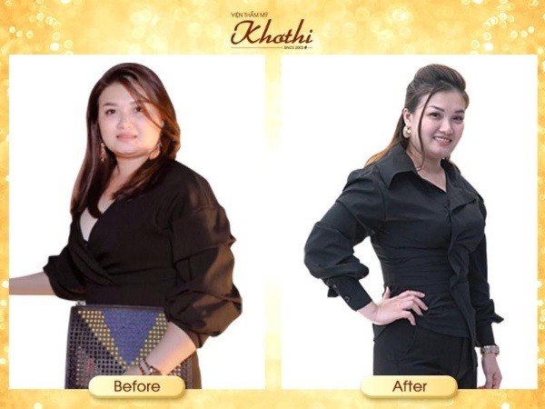 Hiệu quả giảm mỡ vai bằng phương pháp Miko Diet độc quyền tại Khơ Thị