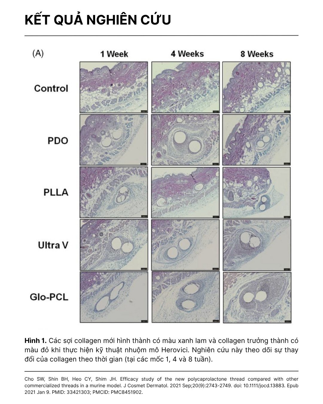 ưu điểm chỉ pcl