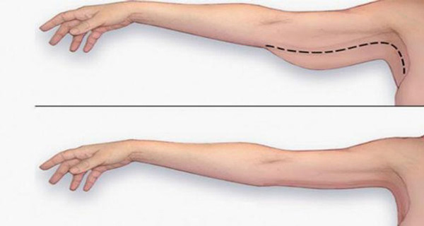 Hút mỡ bắp tay hiệu quả nhưng rủ ro