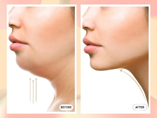 hút mỡ vùng cằm dưới hàm, thực hiện nhanh chóng - hiệu quả lâu dài