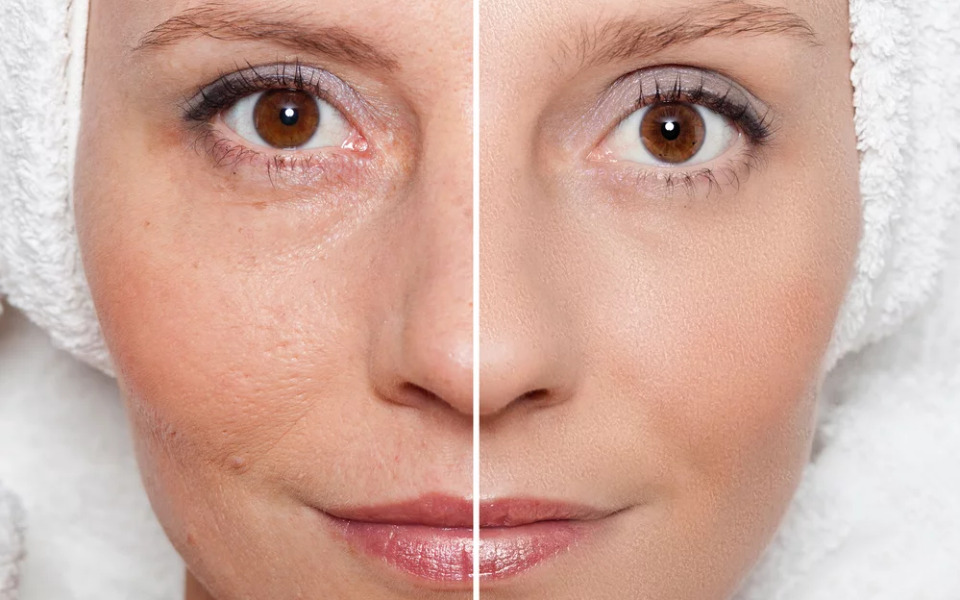 ultherapy