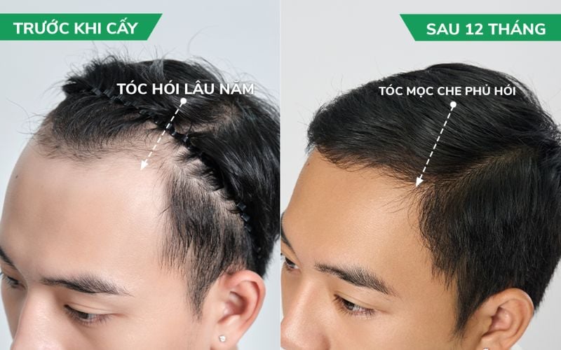 Kết quả sau khi cấy tóc tự thân tại Khơ Thị