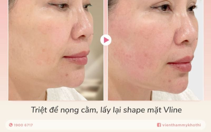 Liên hệ để được cung cấp thông tin Khơ Thị bảng giá dịch vụ Hifu LinearZ xóa nọng cằm