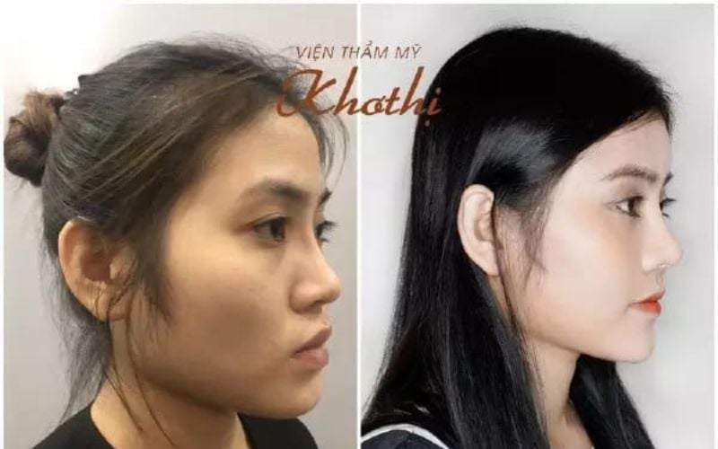 Kết quả nâng mũi tại Viện thẩm mỹ Khơ Thị