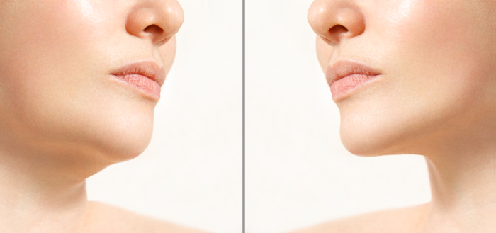 Hãy đảm bảo bạn kiểm tra kĩ nguồn gốc chất filler, thực hiện theo chỉ dẫn và lựa chọn phòng khám cũng như bác sĩ tiêm filler uy tín.