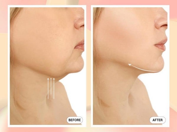 cằm thon gọn tự nhiên sau khi tiêm chất làm đầy