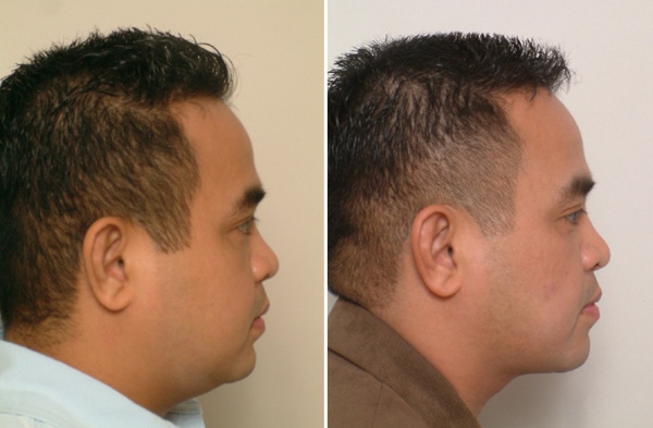 Kiên trì tập các bài tập ở nhà sẽ giúp khuôn mặt gọn gàng hơn