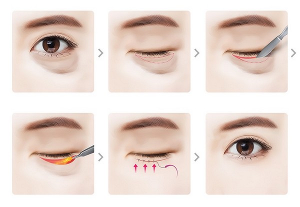 quy trình tiểu phẫu lấy mỡ bọng mắt - cắt da thừa mi dưới