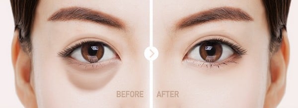 trước và sau khi lấy mỡ bọng mắt