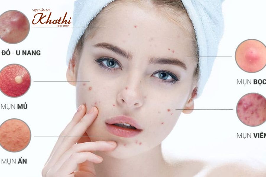Liệu trình điều trị mụn Khơ Thị