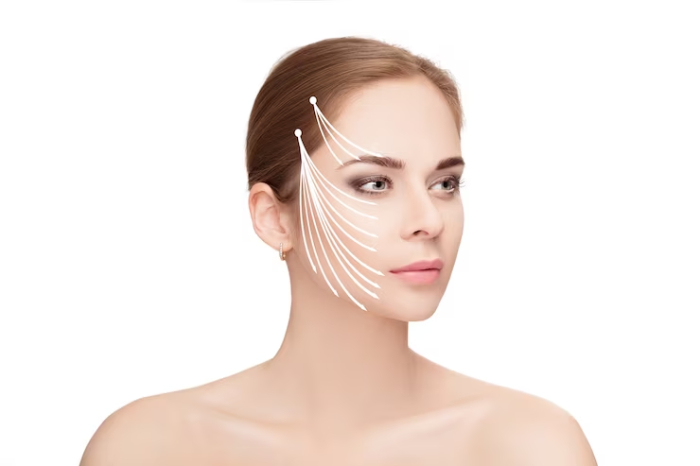 Luồn chỉ collagen không đúng vị trí có thể khiến gương mặt mất cân xứng.
