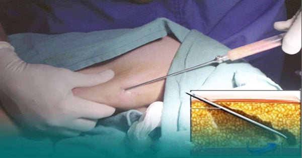 Minh họa phương pháp hút mỡ bắp tay