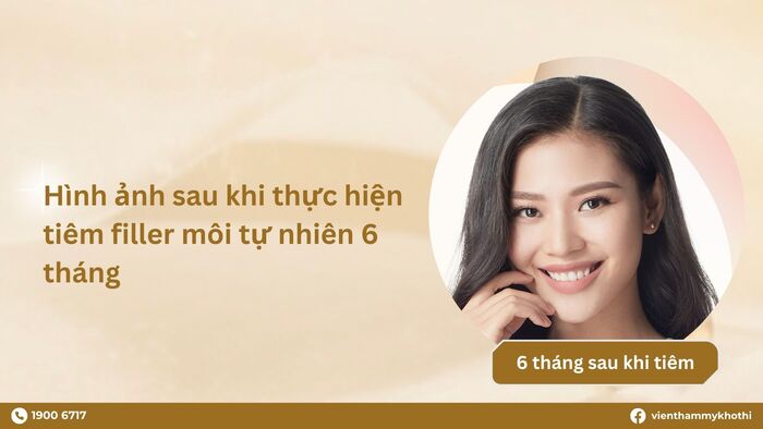 Môi tiêm filler sau 6 tháng sẽ khá giống với thời điểm sau tiêm filler 1 tháng