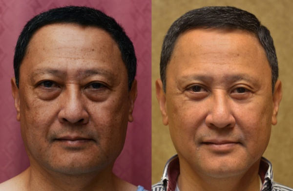 Nâng cơ mặt bằng liệu pháp Ultherapy hiện đại
