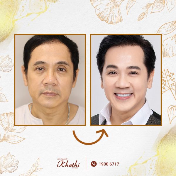 Nâng cơ mặt Spa độc quyền bằng liệu pháp Thermage FLX và Bio enzymes tại Khơ Thị