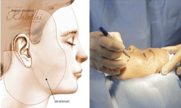 Cần có sự thăm khám và tư vấn của bác sĩ chuyên môn trước khi tiến hành nâng cơ phẫu thuật.