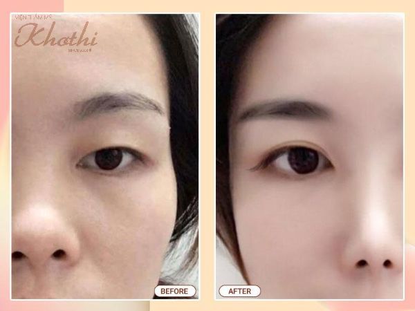 Kết quả mắt trẻ trung, hết da thừa chùng nhão sau khi thực hiện phẫu thuật căng da dưới cung mày.