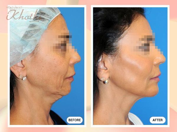 Gương mặt cân đối, hài hòa sau phẫu thuật nâng gò má thẩm mỹ.