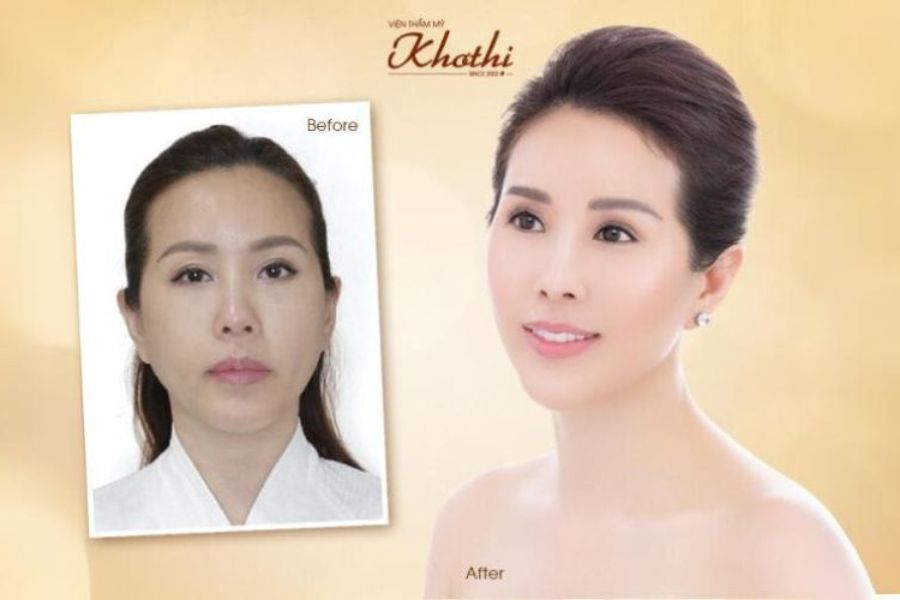 Nâng cơ trẻ hoá Khơ Thị