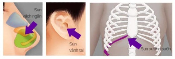 sụn vách ngăn, sụn tai, sụn xương sườn thường được dùng để nâng mũi
