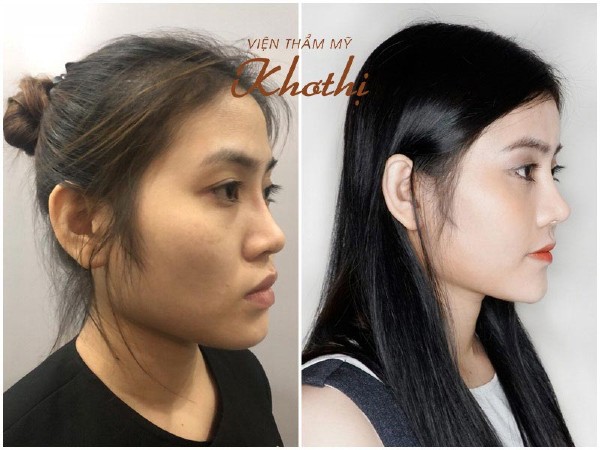 Kết quả nâng mũi bằng sụn siêu mềm K-nose