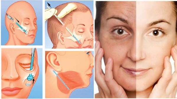 Phẫu thuật căng da mắt nội soi là phương pháp xâm lấn