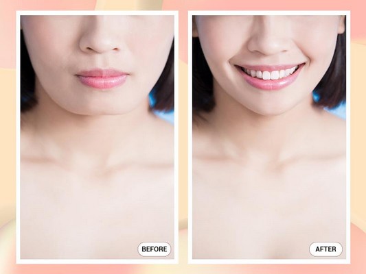 Sở hữu cằm V-line thời thượng ngay sau khi thực hiện