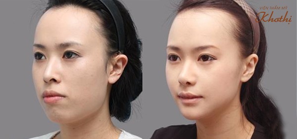 Trước và sau khi Phẫu thuật cắt môi dày thành môi mỏng Trước và sau khi Phẫu thuật cắt môi dày thành môi mỏng