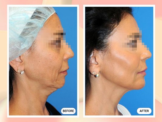 Gương mặt cân đối, hài hòa sau khi phẫu thuật nâng gò má Gương mặt cân đối, hài hòa sau khi phẫu thuật nâng gò má