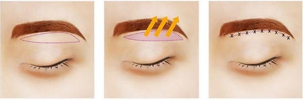 các bước nâng cung chân mày treo sa trễ mi