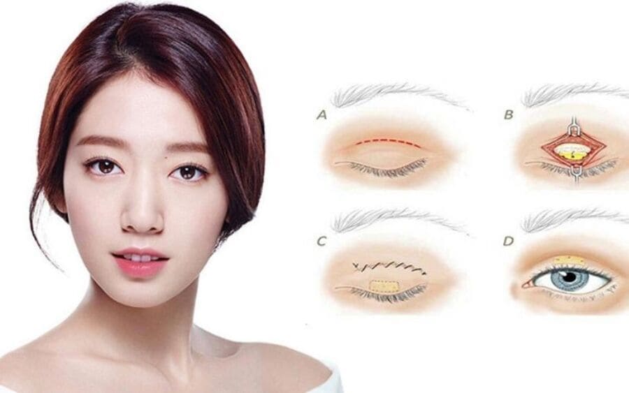 Phẫu thuật phẩm mỹ mắt Khơ Thị