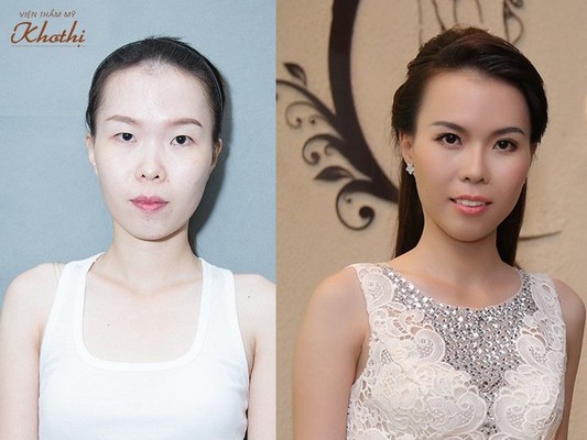 Ngọc Anh trước và sau phẫu thuật cắt mắt và nâng mũi Sline. Ngọc Anh trước và sau phẫu thuật cắt mắt và nâng mũi Sline.