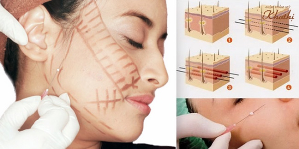 Tổng quát quy trình 6 bước cấy chỉ collagen tại Khơ Thị