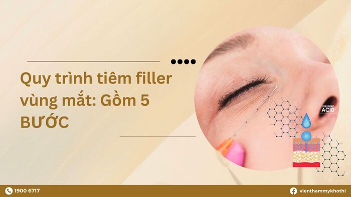 Quy trình thực hiện tiêm filler mắt bao gồm 5 bước chính