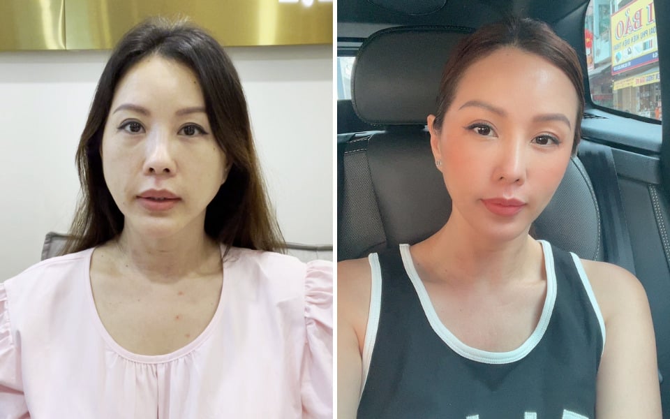 review căng chỉ collagen