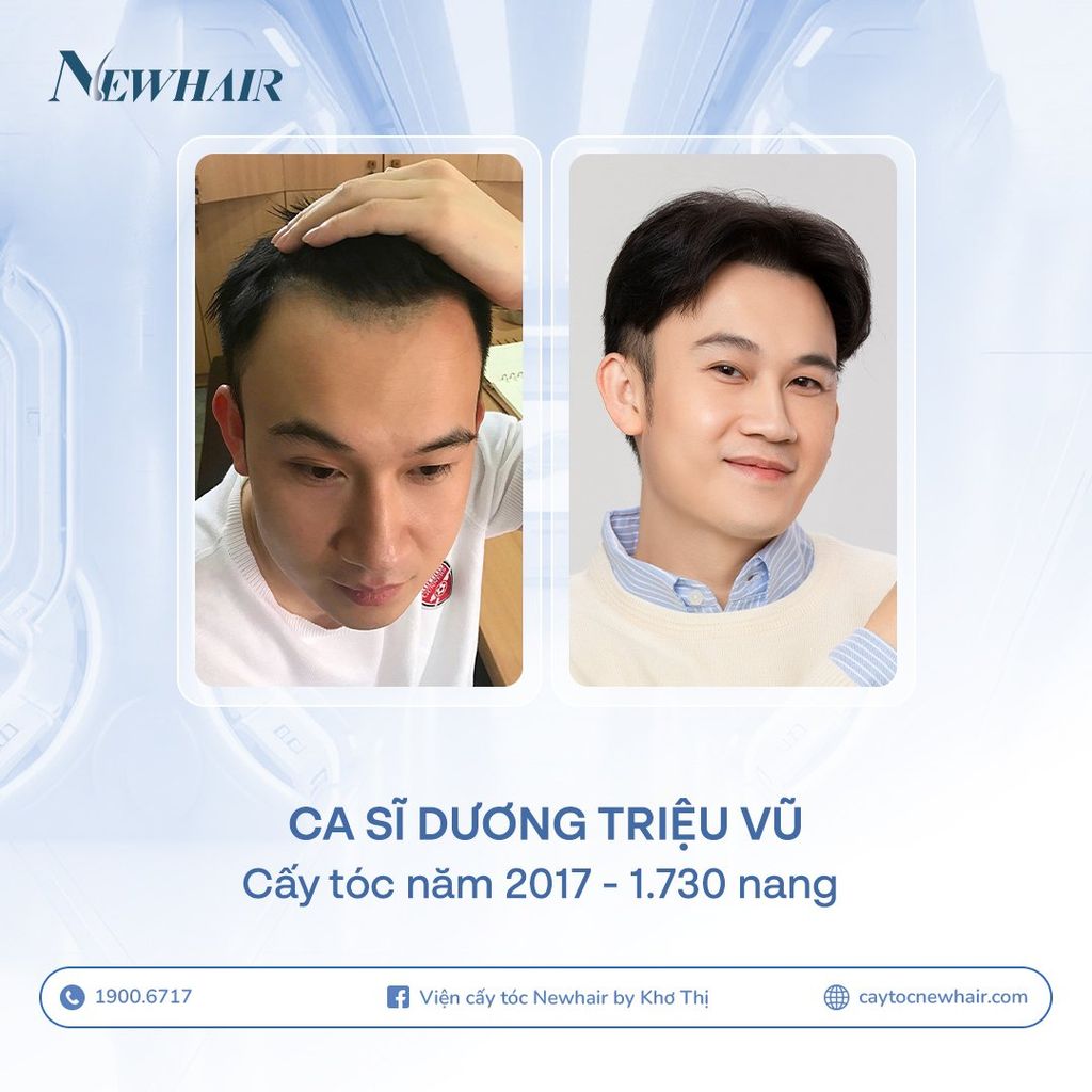 kết quả cấy tóc dương triệu vũ