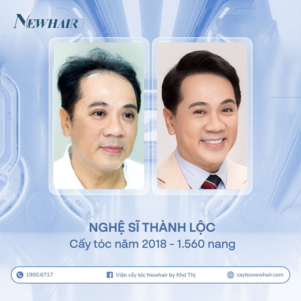 kết quả cấy tóc nsut thành lộc