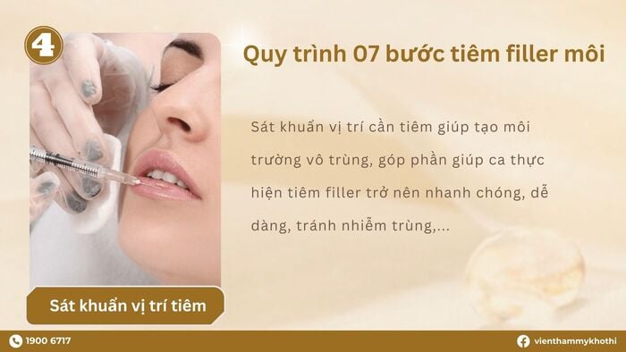 Sát khuẩn vị trí cần tiêm nhằm tạo điều kiện tiệt trùng không vi khuẩn cho khu vực tiêm filler