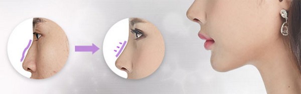 Mài xương chỉnh hình mũi gồ Mài xương chỉnh hình mũi gồ