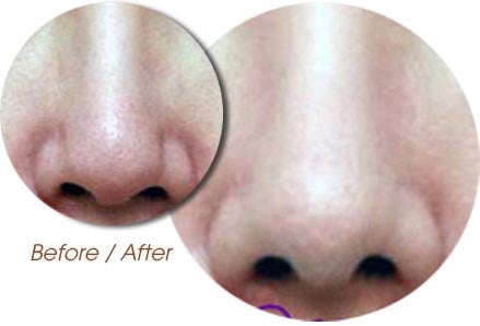 Sửa mũi bị viêm nhiễm sau khi dị ứng chất độn