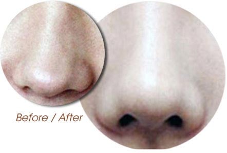 sửa mũi bị lệch sống