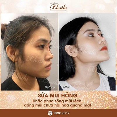 Chỉnh sửa mũi hỏng, khắc phục biến dạng giúp khuôn mặt hài hòa hơn Chỉnh sửa mũi hỏng, khắc phục biến dạng giúp khuôn mặt hài hòa hơn