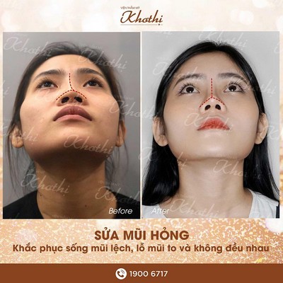 Phẫu thuật chỉnh sửa mũi hỏng, lỗ mũi to không đều Phẫu thuật chỉnh sửa mũi hỏng, lỗ mũi to không đều