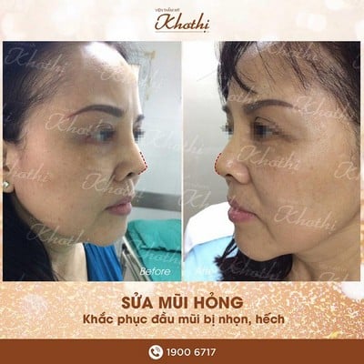 Chỉnh sửa mũi hỏng, đầu mũi nhọn và hếch Chỉnh sửa mũi hỏng, đầu mũi nhọn và hếch